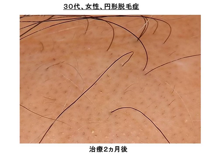 円形脱毛症　病院""